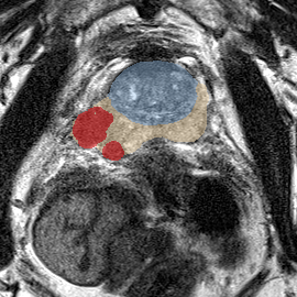 Peripheral-zone lesion, base (Case 33) MRI preview