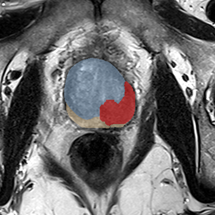 Peripheral-zone lesion, mid-gland (Case 35) MRI preview
