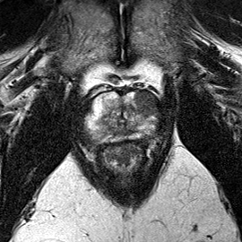 Peripheral-zone lesion, apex (Case 38) T2 axial source preview