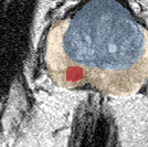 Peripheral-zone lesion, mid-gland (Case 40) lesion zoom preview