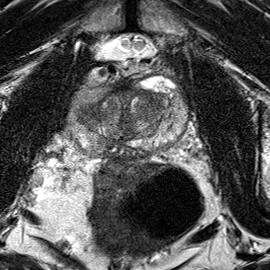 Peripheral-zone lesion, mid-gland (Case 41) T2 axial source preview