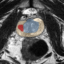 Peripheral-zone lesion, mid-gland (Case 41) MRI preview