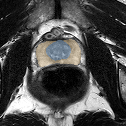Normal gland anatomy, no lesion (Case 43) MRI preview