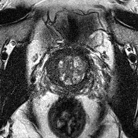 Transition-zone lesion, mid-gland (Case 44) T2 axial source preview