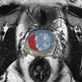 Transition-zone lesion, mid-gland (Case 44) MRI preview