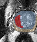 Transition-zone lesion, mid-gland (Case 44) lesion zoom preview