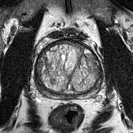 Normal gland anatomy, no lesion (Case 46) T2 axial source preview