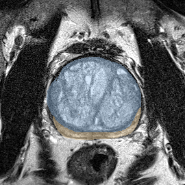 Normal gland anatomy, no lesion (Case 46) MRI preview
