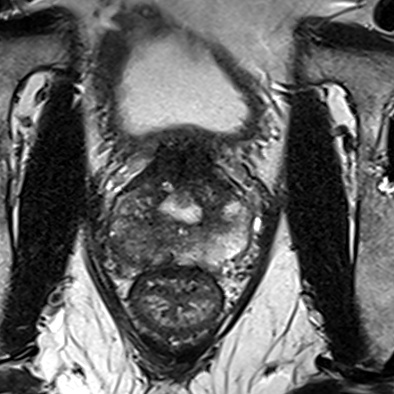 Peripheral-zone lesion, mid-gland (Case 47) T2 axial source preview