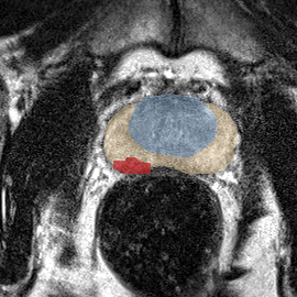 Peripheral-zone lesion, mid-gland (Case 48) MRI preview