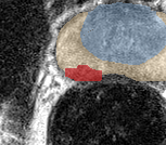 Peripheral-zone lesion, mid-gland (Case 48) lesion zoom preview