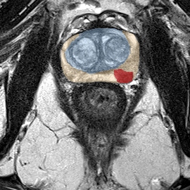 Peripheral-zone lesion, mid-gland (Case 49) MRI preview