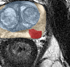 Peripheral-zone lesion, mid-gland (Case 49) lesion zoom preview