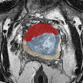 Transition-zone lesion, base (Case 51) MRI preview
