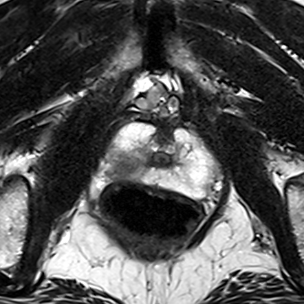 Peripheral-zone lesion, apex (Case 52) T2 axial source preview