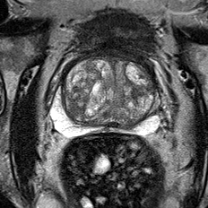 Normal gland anatomy, no lesion (Case 53) T2 axial source preview