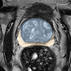 Normal gland anatomy, no lesion (Case 53) MRI preview