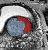 Transition-zone lesion, base (Case 54) lesion zoom preview