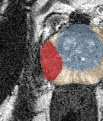 Peripheral-zone lesion, mid-gland (Case 55) lesion zoom preview