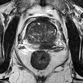 Peripheral-zone lesion, mid-gland (Case 56) T2 axial source preview