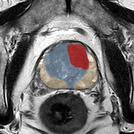 Transition-zone lesion, mid-gland (Case 58) MRI preview