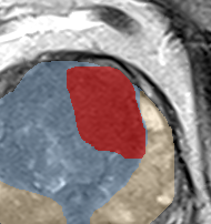 Transition-zone lesion, mid-gland (Case 58) lesion zoom preview