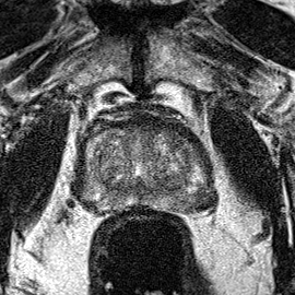 Peripheral-zone lesion, apex (Case 59) T2 axial source preview
