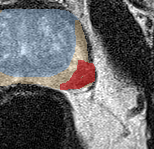 Peripheral-zone lesion, apex (Case 59) lesion zoom preview