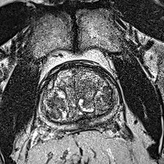 Normal gland anatomy, no lesion (Case 60) T2 axial source preview