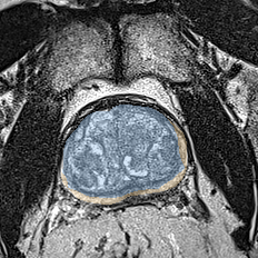 Normal gland anatomy, no lesion (Case 60) MRI preview