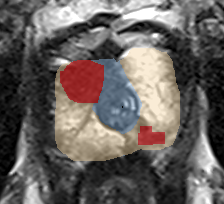 Peripheral-zone lesion, apex (Case 61) lesion zoom preview