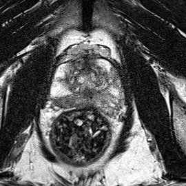 Peripheral-zone lesion, mid-gland (Case 62) T2 axial source preview
