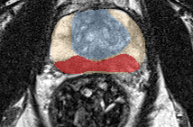 Peripheral-zone lesion, mid-gland (Case 62) lesion zoom preview