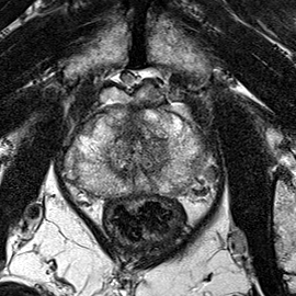 Normal gland anatomy, no lesion (Case 63) T2 axial source preview