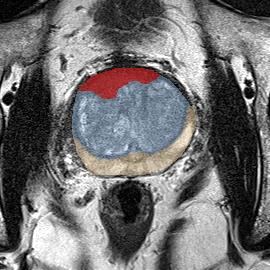 Transition-zone lesion, mid-gland (Case 64) MRI preview
