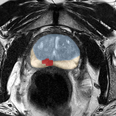Peripheral-zone lesion, apex (Case 65) MRI preview