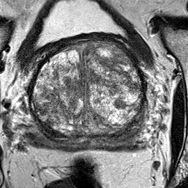 Normal gland anatomy, no lesion (Case 66) T2 axial source preview