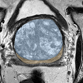 Normal gland anatomy, no lesion (Case 66) MRI preview