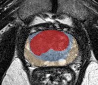 Transition-zone lesion, apex (Case 67) lesion zoom preview