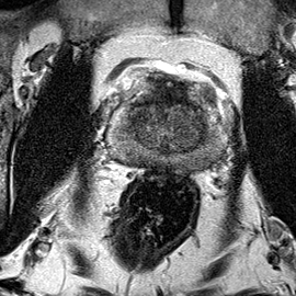 Peripheral-zone lesion, mid-gland (Case 68) T2 axial source preview