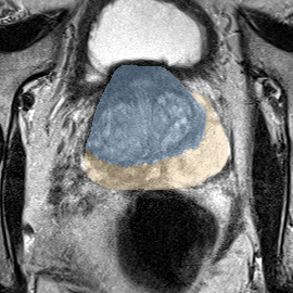 Normal gland anatomy, no lesion (Case 69) MRI preview