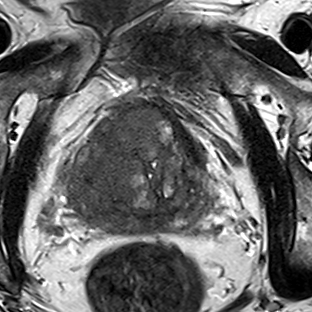 Transition-zone lesion, base (Case 70) T2 axial source preview