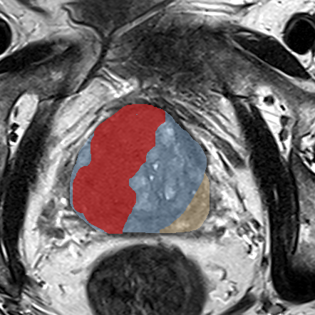 Transition-zone lesion, base (Case 70) MRI preview