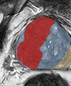 Transition-zone lesion, base (Case 70) lesion zoom preview