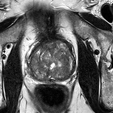 Normal gland anatomy, no lesion (Case 71) T2 axial source preview