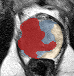 Transition-zone lesion, mid-gland (Case 72) lesion zoom preview