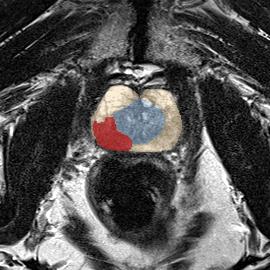 Peripheral-zone lesion, mid-gland (Case 73) MRI preview