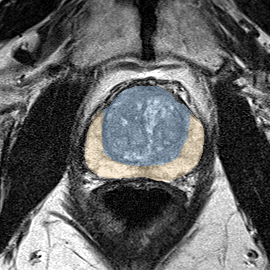 Normal gland anatomy, no lesion (Case 74) MRI preview
