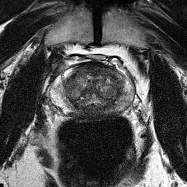 Transition-zone lesion, mid-gland (Case 75) T2 axial source preview
