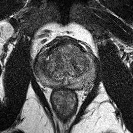 Normal gland anatomy, no lesion (Case 76) T2 axial source preview